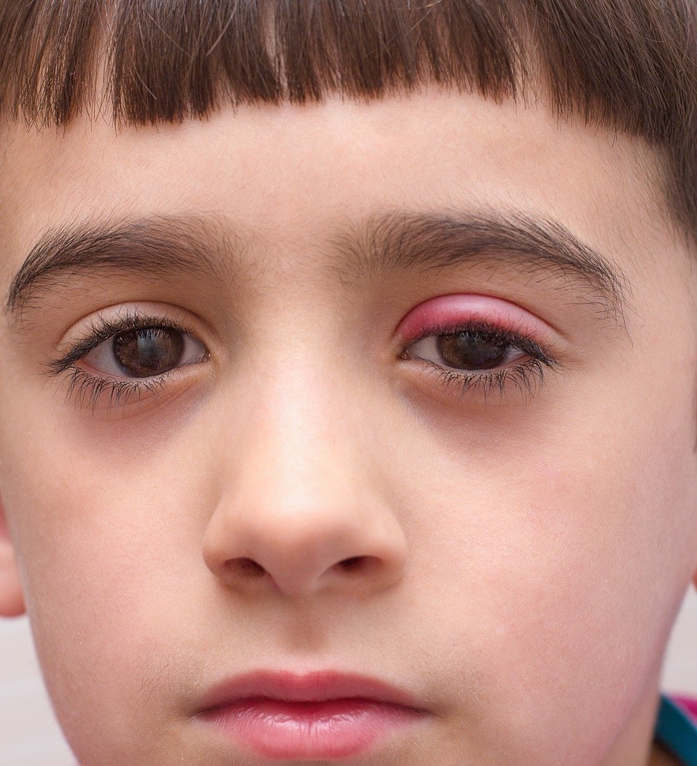аллергический конъюнктивит у детей фото