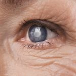 Stem Cells May Cure Cataracts and Restore Sight in the Future