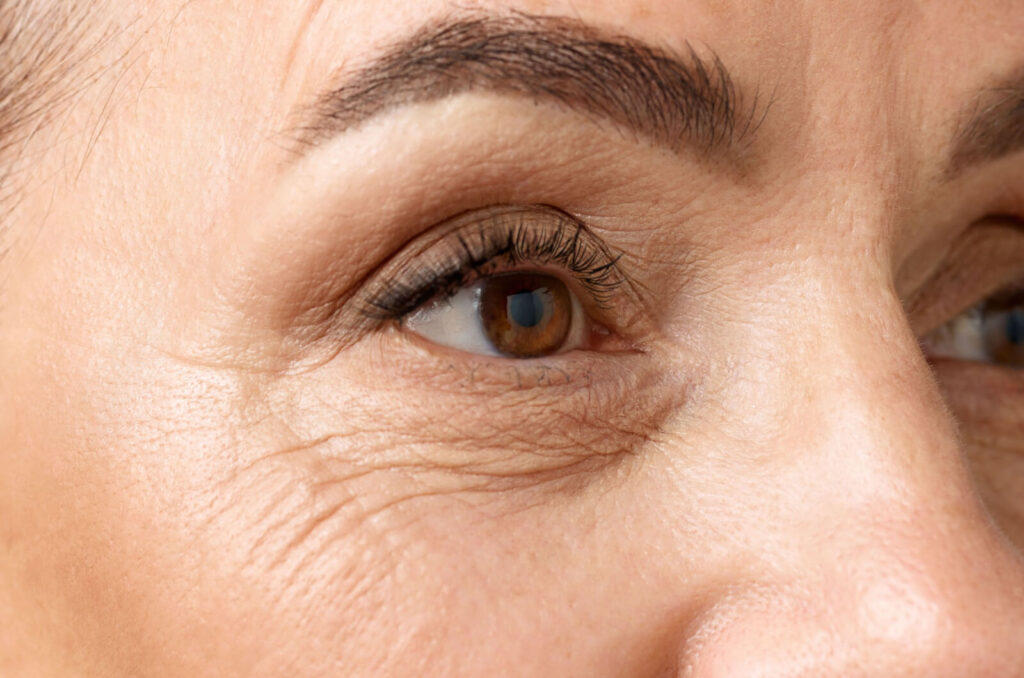 Close-up of the eyes of an older adult who is suffering from macular degeneration.