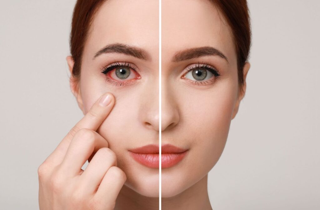 Split screen of a person with one red eye and one healthy eye points at their irritated eye.